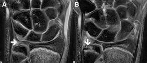 A Mri Study Showing A Tear Arrow In The Ulnar Portion Of The Tfcc