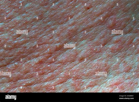 Blister Texture Hi Res Stock Photography And Images Alamy