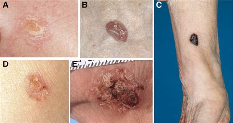 Clinical Presentations Of Skin Cancers Or Their Precursors A Actinic