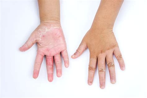 Dermatitis Kontak Gejala Penyebab Diagnosis Pengobatan