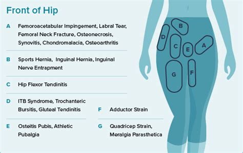 Hip Pain Location Diagram Town Center Orthopaedics