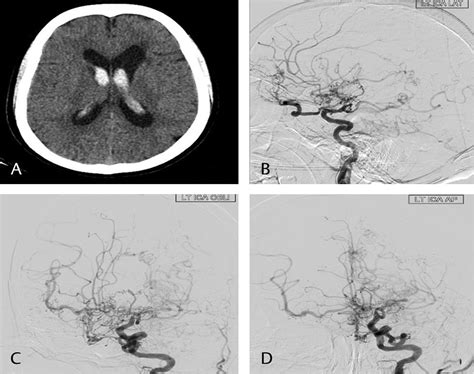 Adult Primary Intraventricular Hemorrhage Clinical Characteristics And