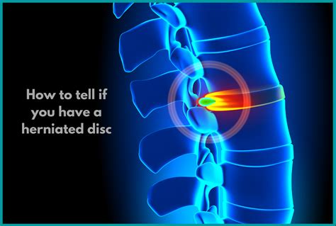 How To Tell If You Have A Herniated Disc Causes Symptoms Treatment