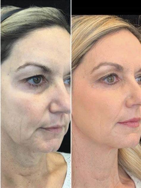 A New Non Invasive Skin Tightening Treatment You Need To Know About