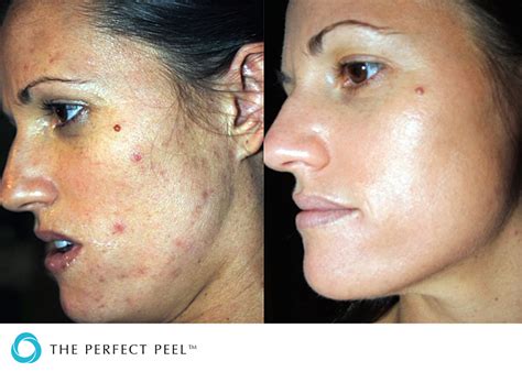 The Perfect Peel Real You Clinic Twickenham And Richmond