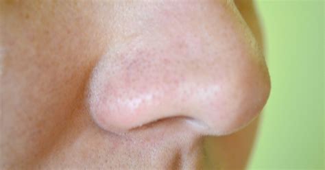 How To Get Rid Of Blackheads On Your Nose Without Leaving Holes