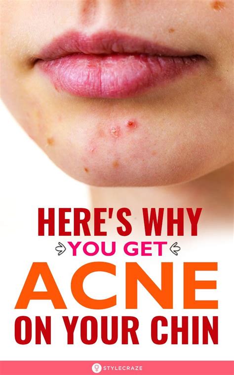 What Is Chin Acne Caused By Surffishinga