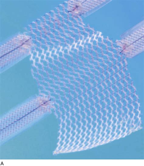 Trocar Based Synthetic Mesh Kits Used To Correct Pelvic Organ Prolapse