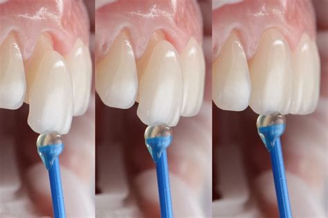 Learn Why Veneers Don T Require Major Teeth Shaving