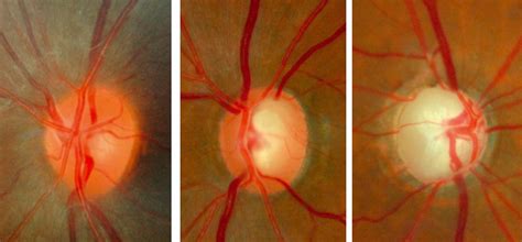 What Is Glaucoma What Causes Glaucoma Simple Answer Eye CU