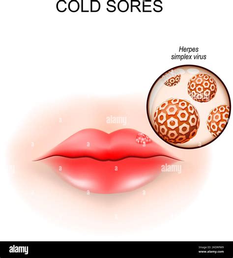 Cold Sores In The Lip Fever Blisters Close Up Of A Herpes Simplex