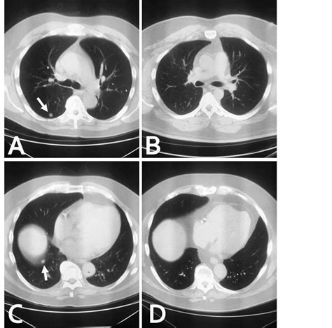 Chest Ct Scans Demonstrated Two Noncalcified 80 Mm Pulmonary Nodules
