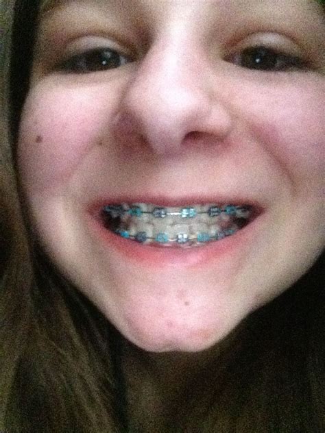 Teal And Navy Blue Braces Colors Nose Ring Teal