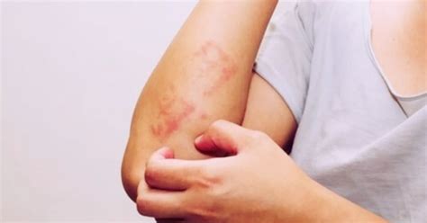 Come Curare La Dermatite Da Stress Con Rimedi Naturali Efficaci