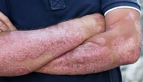 What Is Psoriasis And How To Prevent It