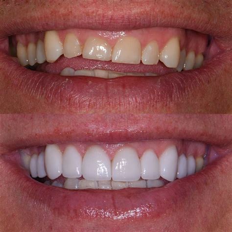 Veneers Turkey Per Tooth Special Techniques Medaway