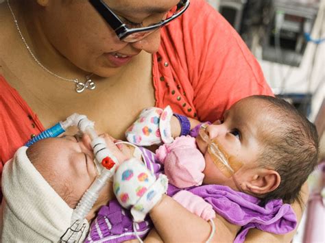 Texas Conjoined Twins Await Surgery To Lead Separate Lives Abc News