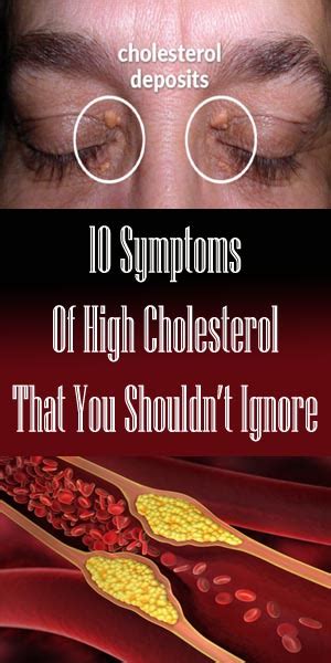 10 Symptoms Of High Cholesterol That You Shouldnt Ignore Nutrition