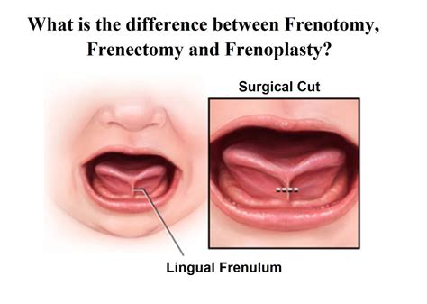 What Is The Difference Between Frenotomy Frenectomy And Frenuloplasty