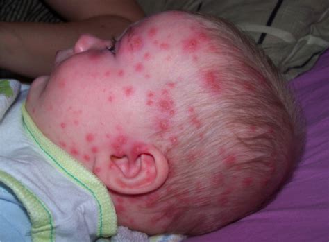 Spots And Rashes How To Recognise The Illnesses That Affect Children