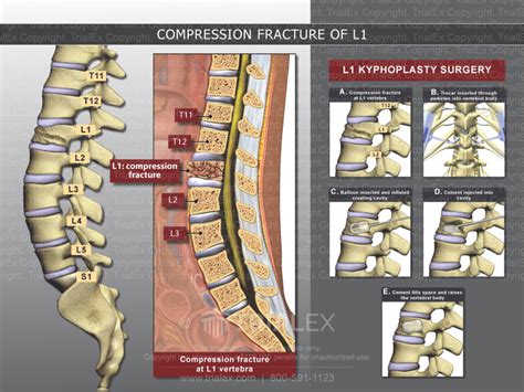 Compression Fracture Of L1 Trial Exhibits Inc