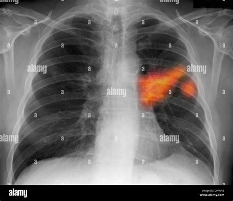 Chest X Ray Of A Smoker Showing Lung Cancer Stock Photo Alamy