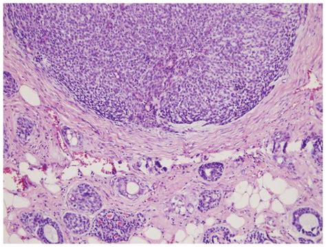 Adenoid Cystic Carcinoma Of The Breast A Case Report And Literature Review