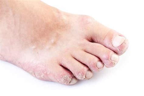 Palmoplantar Keratoderma Overview Symptoms Causes Prevention And