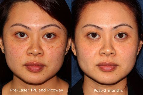 Laser Freckle Removal Before And After Shiderfaruolo