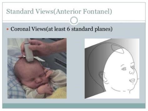 Draft Neonatal Head Normal Ultrasoundpaedia 957