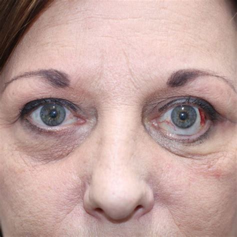 Before And After Thyroid Eye Disease