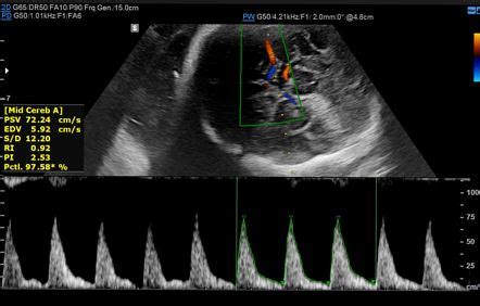Fetal Middle Cerebral Arterial Doppler Assessment Radiology Reference