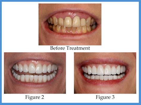 How Long Does The Porcelain Veneers Process Take Konig Center For