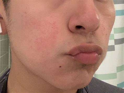 Help Is This Rosacea Or Acne Rosacea And Facial Redness