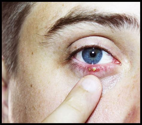 Close Up Mans Eye Ophthalmologic Disease Hordeolum Eye Doctor