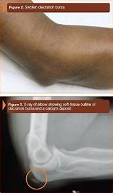 What Doctor To See For Elbow Bursitis Photos