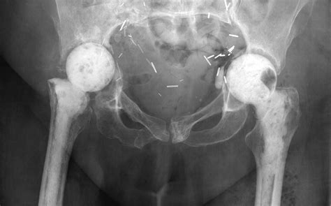 Acetabular Revision Using An Anti Protrusion Ilio Ischial Cage And
