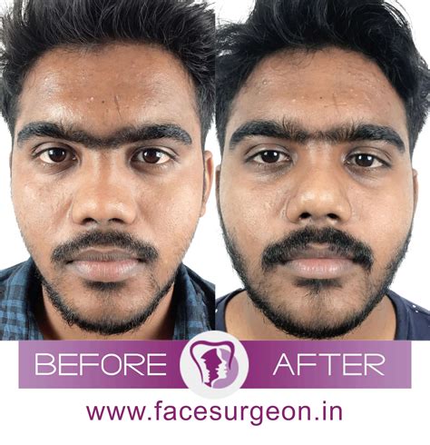 Nose Job For Wide Nose Before And After