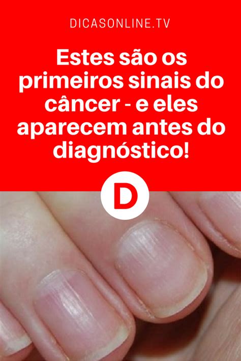 Sintomas De Câncer Um Desses Sinais é Nas Unhas Saiba Tudo Sobre Ele