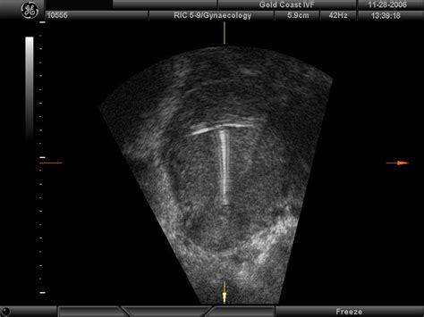 Wk 2 L 1 Iud Computer Corrected View Of Iud Iud Sonography Ultrasound