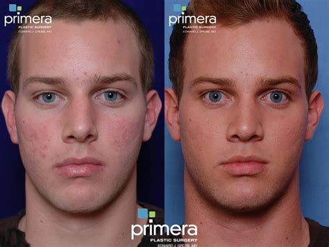 Dermabrasion Before And After Pictures Case 80 Orlando Florida