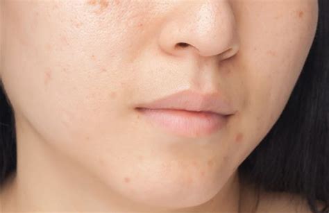 Textured Skin Causes Tips And Remedies