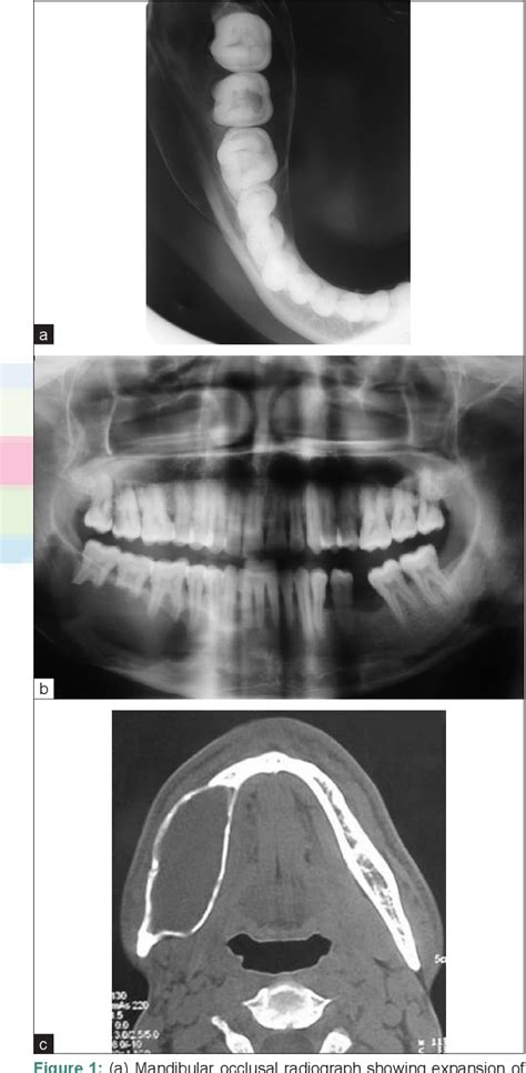 Figure 1 From Aneurysmal Bone Cyst Of The Mandible A Case Report And