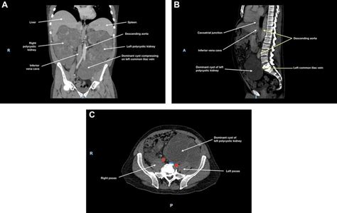 A Coronal B Sagittal And C Axial Views Of The Patients Ct Scan