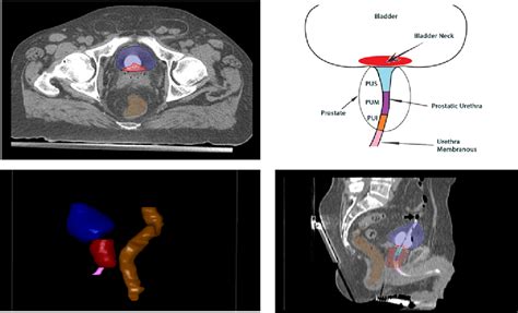 Pdf Hdr Brachytherapy As Monotherapy For Low Risk Prostate Cancer Dosimetric And Clinical