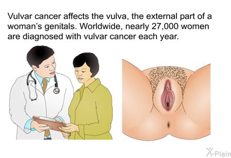 Patedu Vulvar Cancer