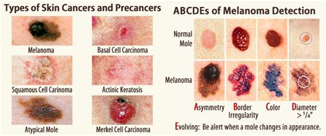 Make Sure Skin Cancer Is Not In Your Future