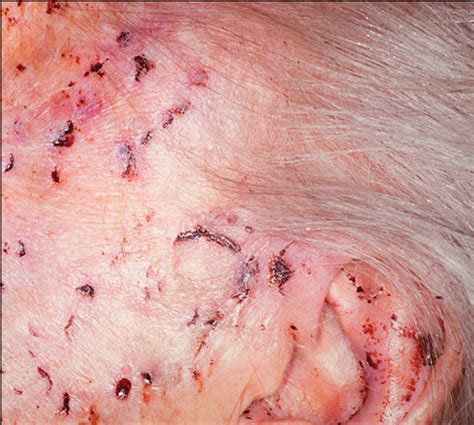 Sharply Demarcated Incisions Caused By Rat Bites Emergency Medicine