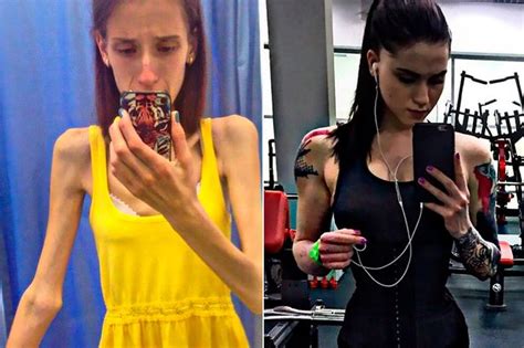 Bulimic Student Survived On 150 Calories A Day After Hating How Her
