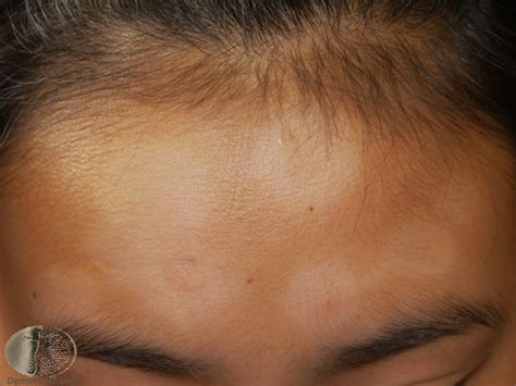 Pityriasis Alba Photo Gallery Dr Dilshaad Asmal Dermatologist Cape Town